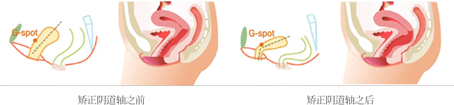 阴Գ BR阴Գ紧缩术
